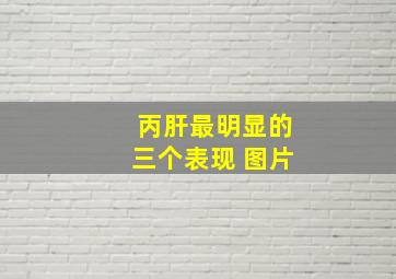 丙肝最明显的三个表现 图片